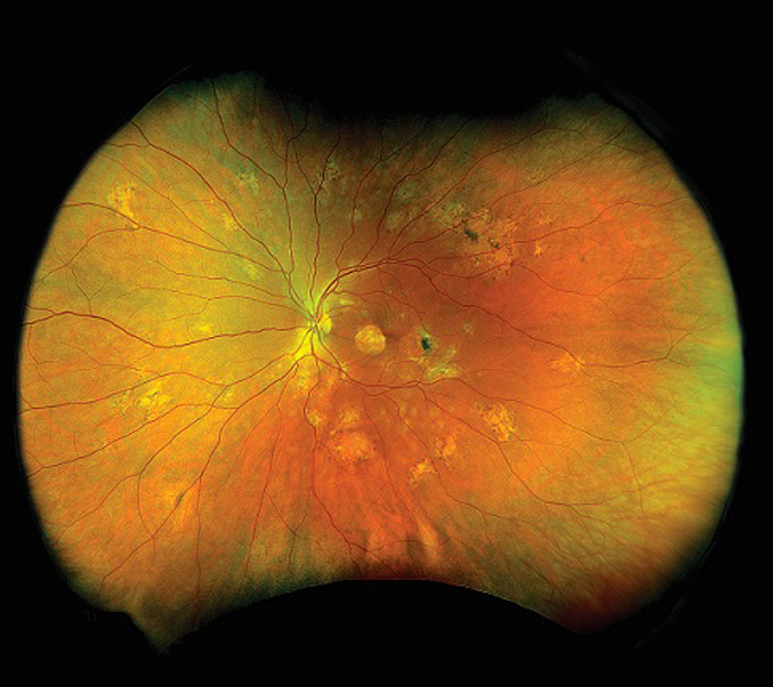 Optomap couleur